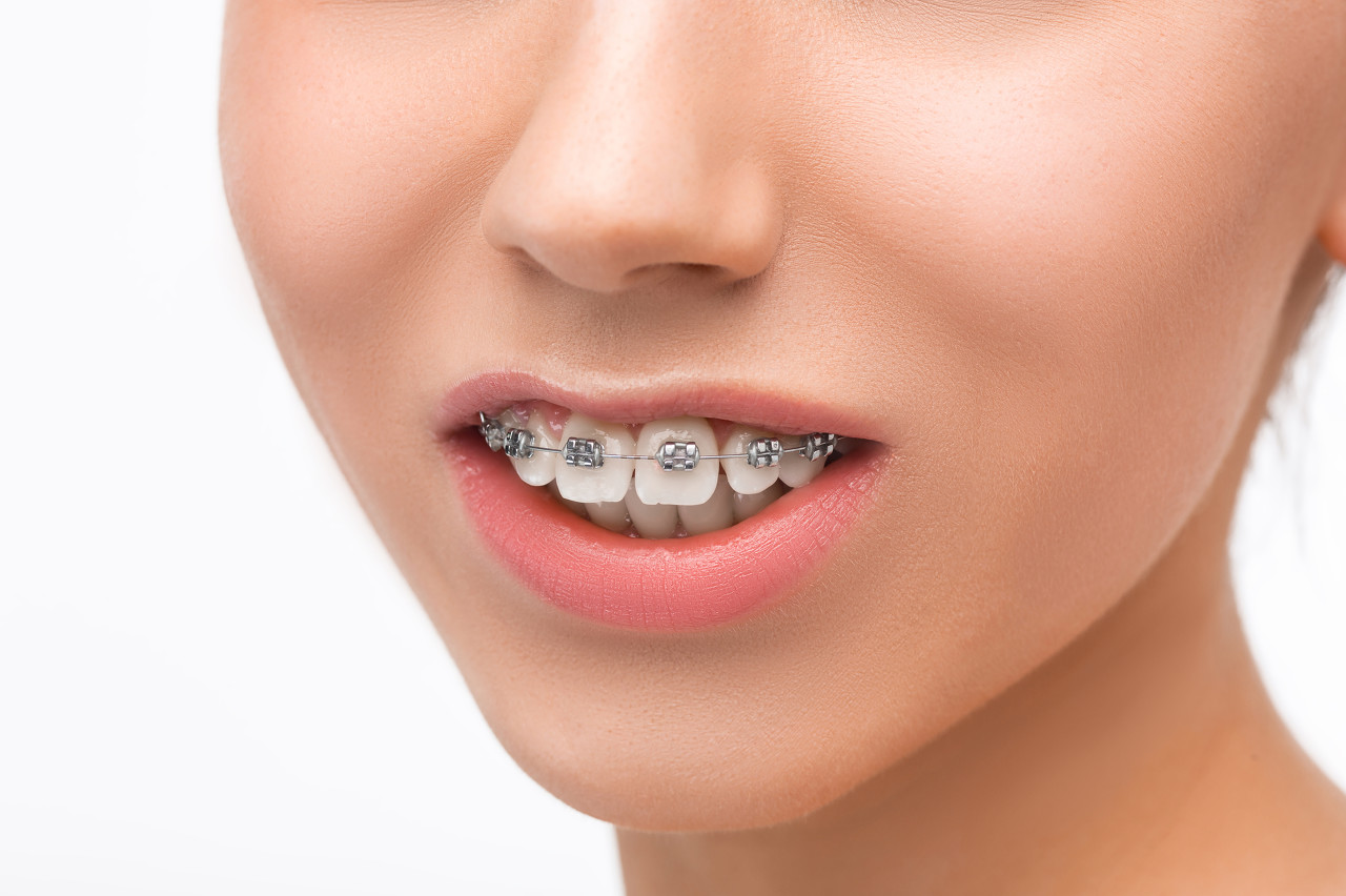 牙齿矫正会导致黑三角吗？如何治疗黑三角？