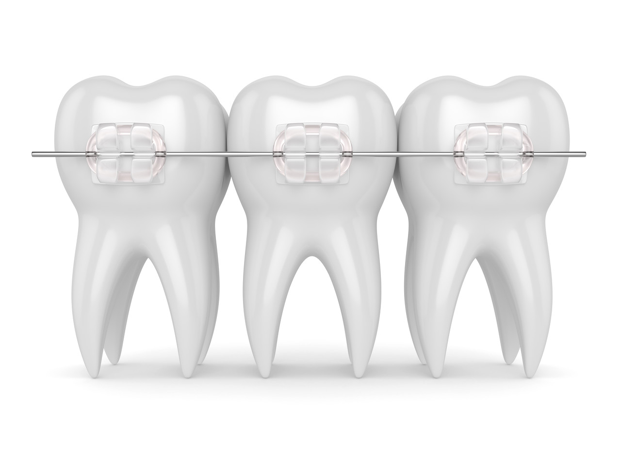 什么是牙齿二次矫正，如何避免牙齿二次矫正？