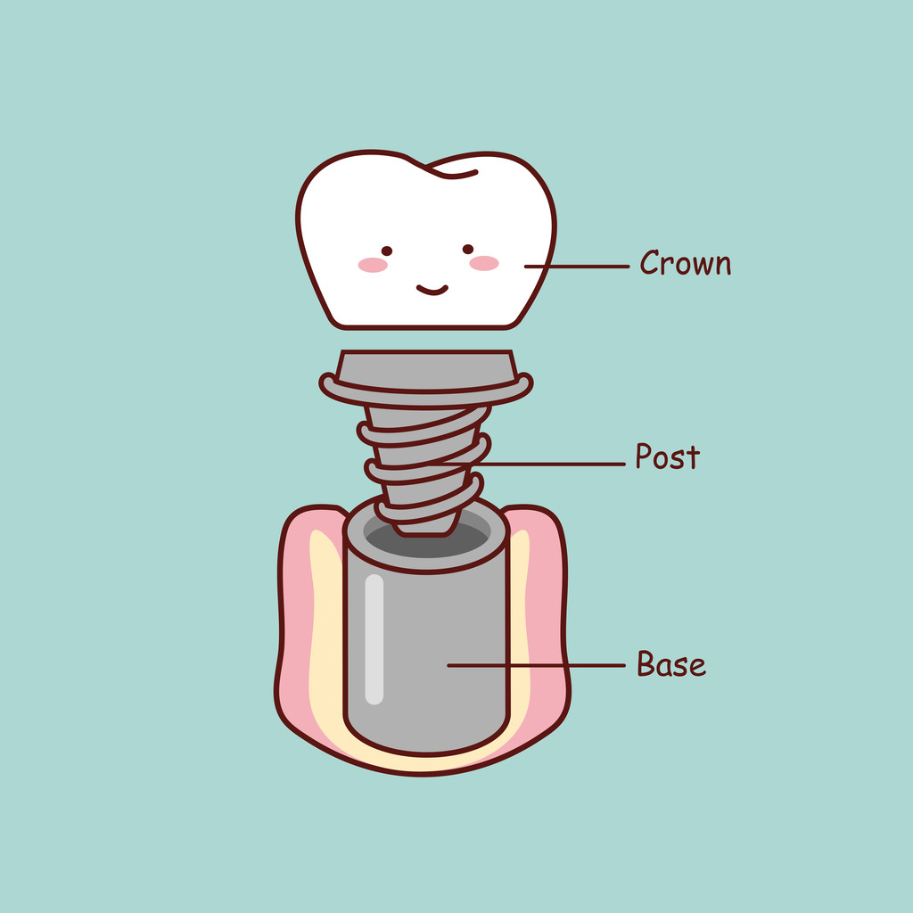 对金属过敏能做种植牙吗？深圳种植牙齿哪个医院比较好？