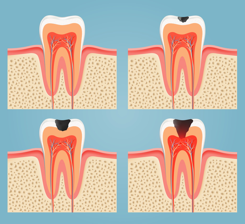 补牙后牙齿发酸怎么回事？深圳社保补牙可以报销吗？