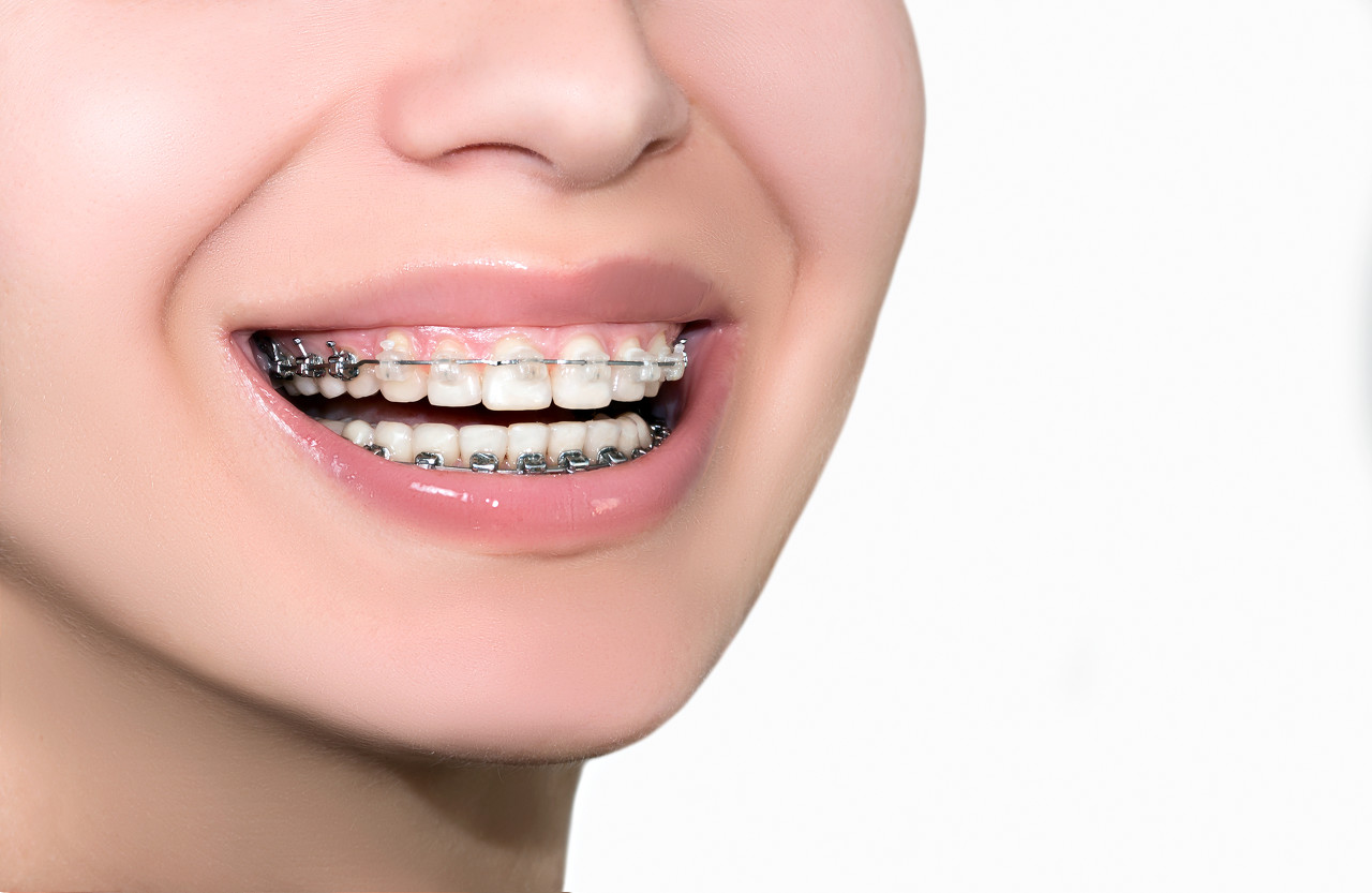 牙齿矫正可以只做半口吗?深圳牙齿矫正好的医院？