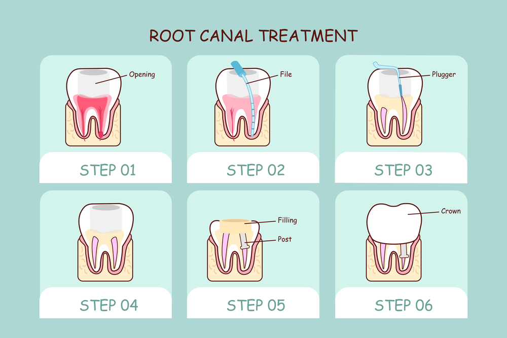 哪些牙齿需要做根管治疗？深圳根管治疗多少钱？