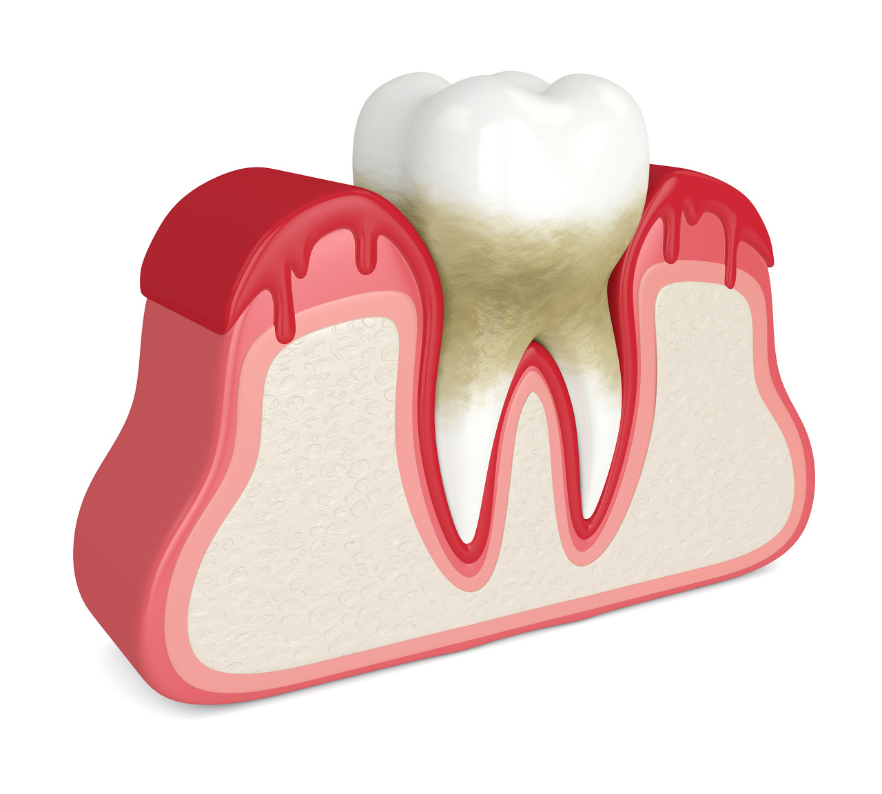 牙齿松动怎么治疗？深圳牙齿松动矫正医院哪个好些？