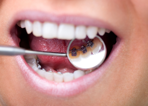 什么是舌侧矫正？哪些牙齿情况适合做舌侧矫正?深圳牙齿矫正哪家医院比较好？