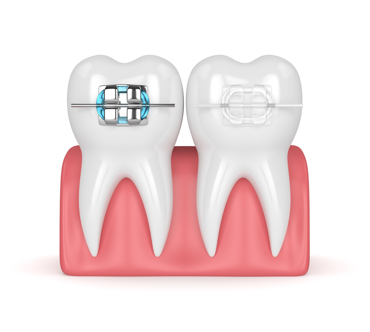骨性龅牙可以做牙齿矫正吗？牙齿矫正深圳哪家医院做得好？