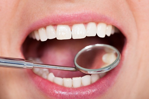 牙齿长期不洗牙结石多会怎样