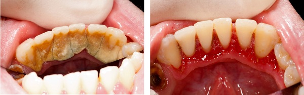 洗牙和牙周刮治的区别