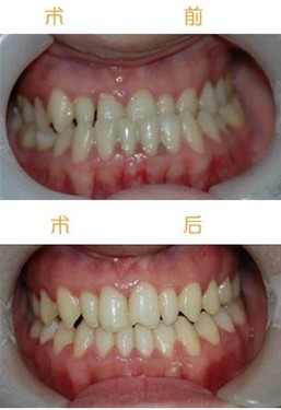 牙齿反颌矫正