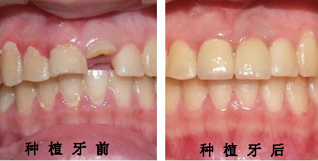 缺牙后为什么要及时修复? 缺牙后为什么要及时修复?