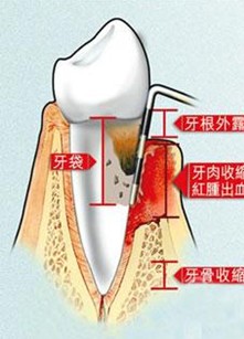 牙齿疼痛的病症和症状？