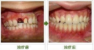 种植牙效果图