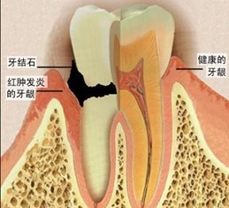 牙结石的危害