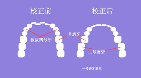 成年人牙齿矫正