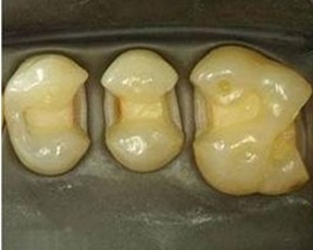 补大牙用什么材料