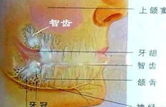 拔智齿