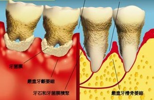 牙周炎易患人群有4种 牙周炎易患人群有4种
