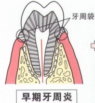 牙周病的五步治疗法!