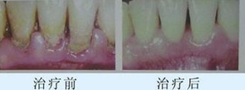 牙周炎吃什么药好得快