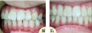 牙齿矫正后会不会反弹