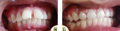 幼儿牙齿稀疏到底正常吗？