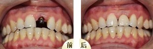 门牙掉了可以种植吗