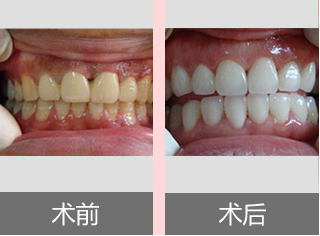 牙齿发黄哪种美白效果好