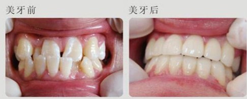 牙齿拥挤怎么矫正效果好