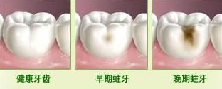 牙齿里面有个黑色的小洞怎么办