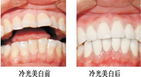 黄牙怎么美白