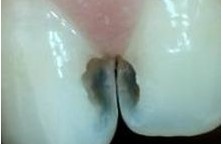 蛀牙引起牙痛反复发作怎么办