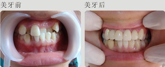 牙齿矫正后会不会松动反弹