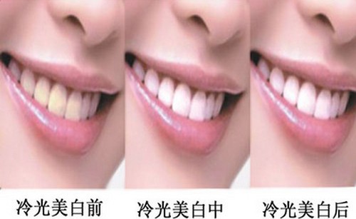冷光美白的效果好不好