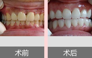 美白牙齿哪种方法较有效、较安全