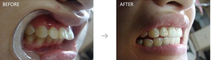 门牙稍微有点前突