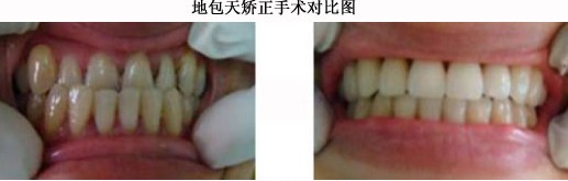 地包天怎么矫正