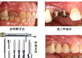 半 口 种 植 牙适合那些人? 半 口 种 植 牙适合那些人?