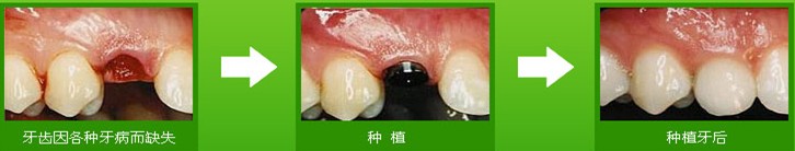 门牙掉了怎么修补