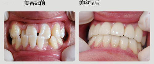 儿童牙齿外突怎么治疗