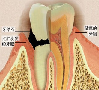 牙龈炎平时怎么处理！