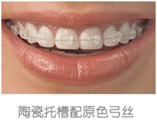 隐形矫正