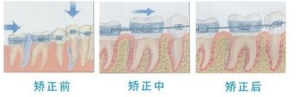 牙齿矫正期间四大注意事项