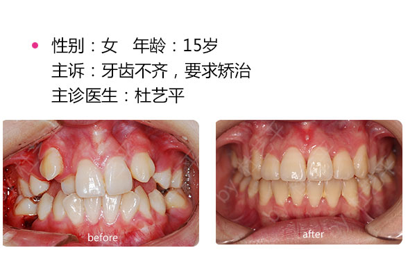 牙齿不齐