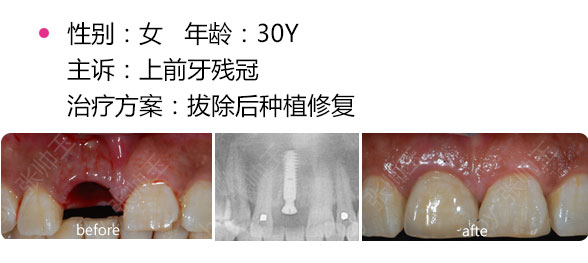 深圳关内做种植牙多少钱？