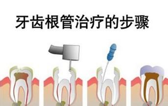根管治疗一般需要多少钱
