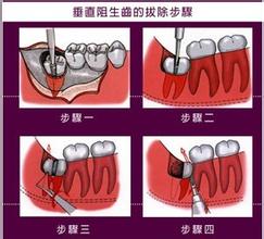 深圳拔智齿多少钱一颗？