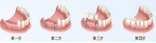 种植牙如何避免“盲种”？