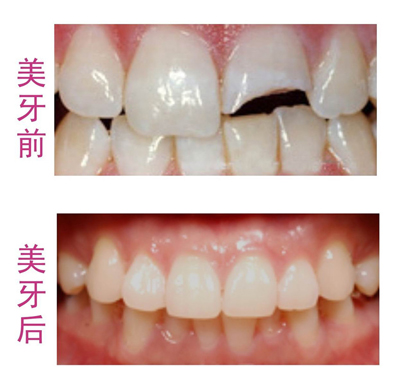 烤瓷牙何时更换比较好？