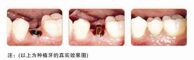 缺牙时间久了还能种牙吗？
