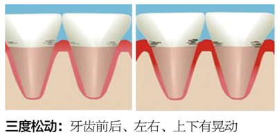 牙齿松动怎么治疗？