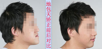 深圳地包天矫正多少钱？